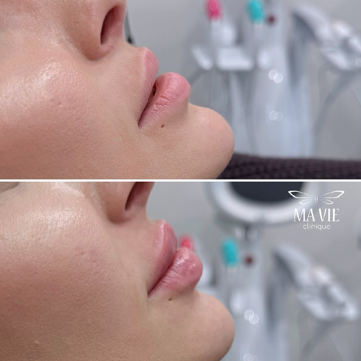 До/после нашей пациентки в профиль