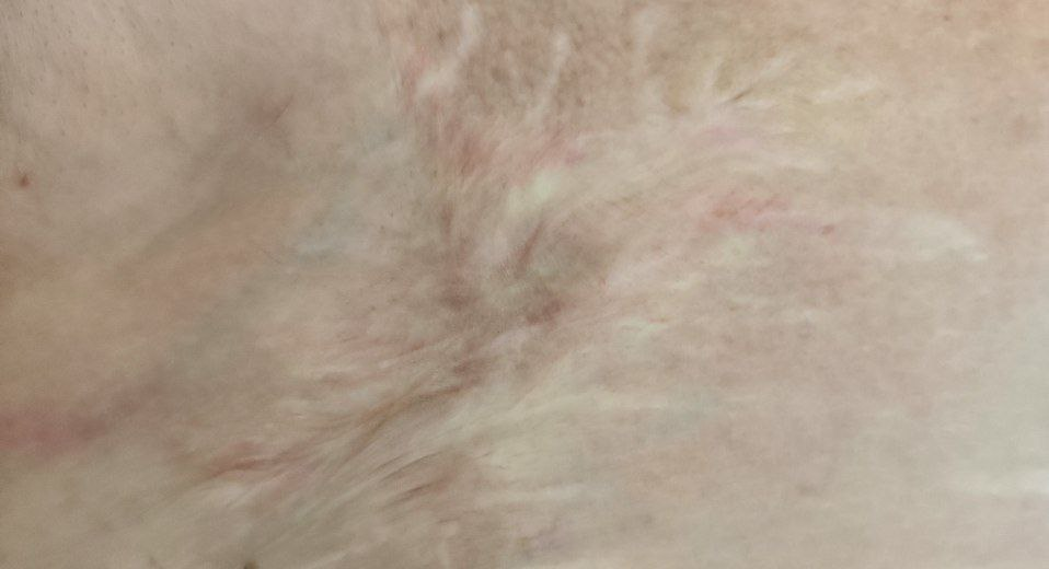 рецидив опухоли в рубце