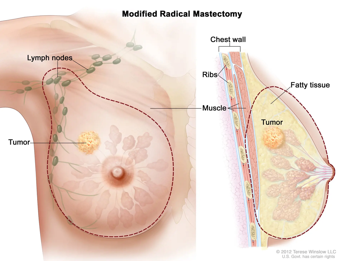https://www.facs.org/for-patients/the-day-of-your-surgery/breast-cancer-surgery/understanding-your-operation/mastectomy/