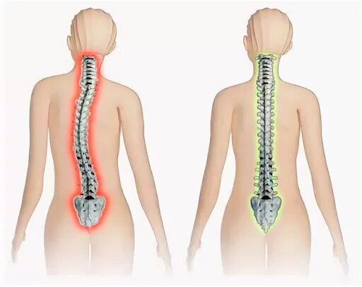 Сравнение здорово позвоночника и с деформацией