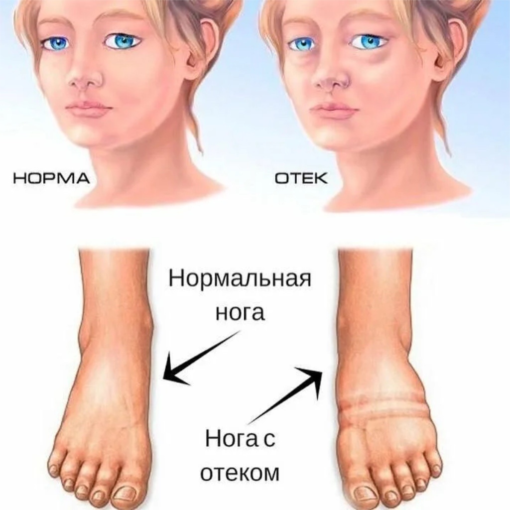 Пример отеков