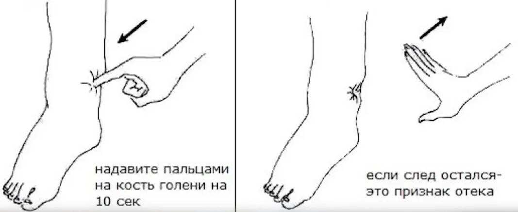 Способ определения отеков