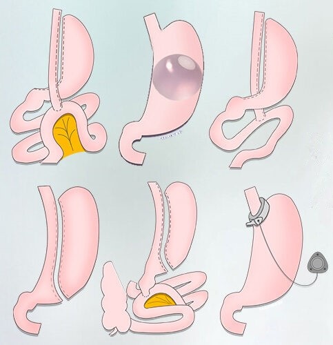 Виды бариатрических операций