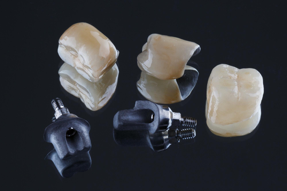 Металлокерамические коронки с металлом в основании и керамической облицовкой снаружи