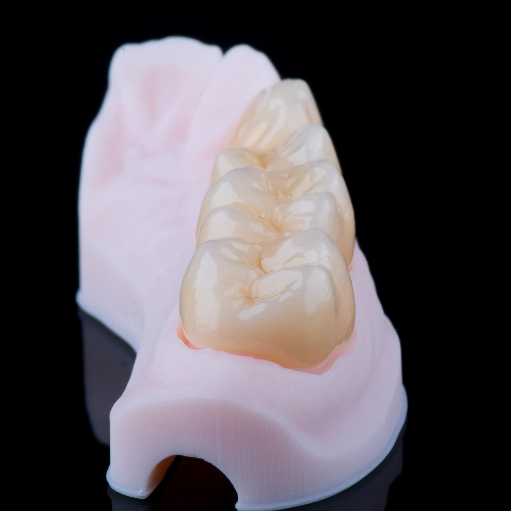 Циркониевая коронка без металлического каркаса