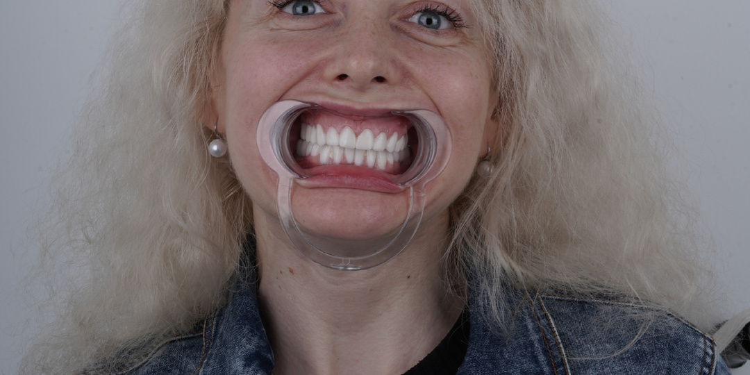 Во сколько обошлись мои новые зубы