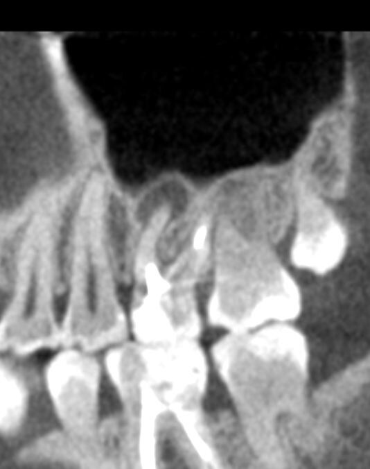 Киста на корне зуба размером 4 на 7 см. Компьютерная томография.
