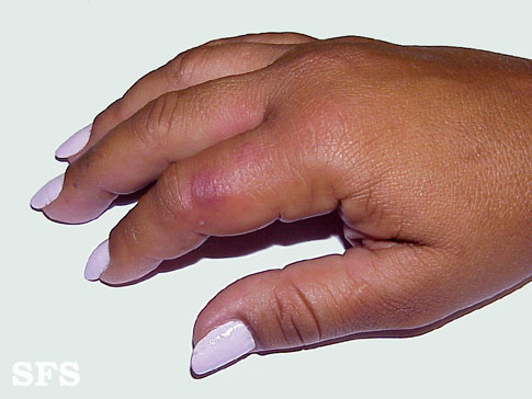 РОЖА РОЗЕНБАХА