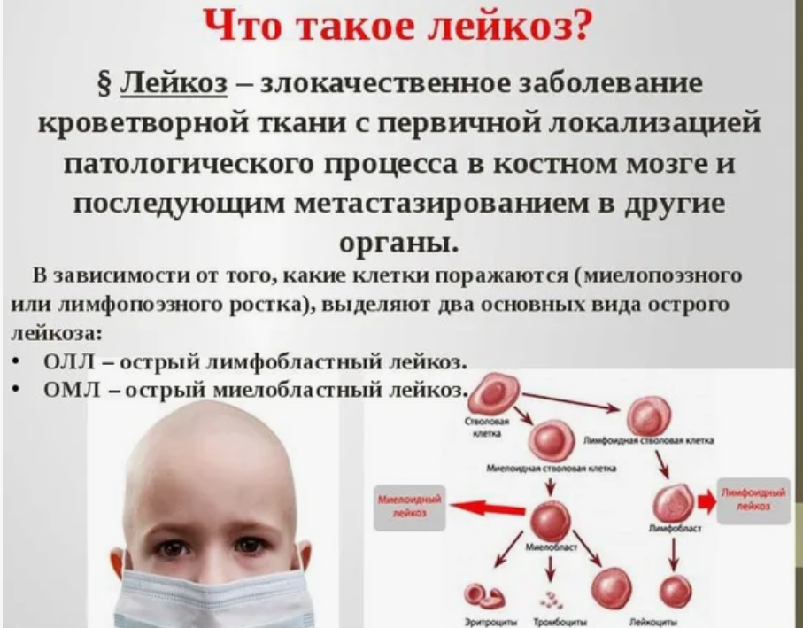 Лейкемия что это за болезнь причины. Лейкемия что это за болезнь причины. Белокровие симптомы у детей. Treatment types in acute leukemia. Лейкемия что это за болезнь причины.