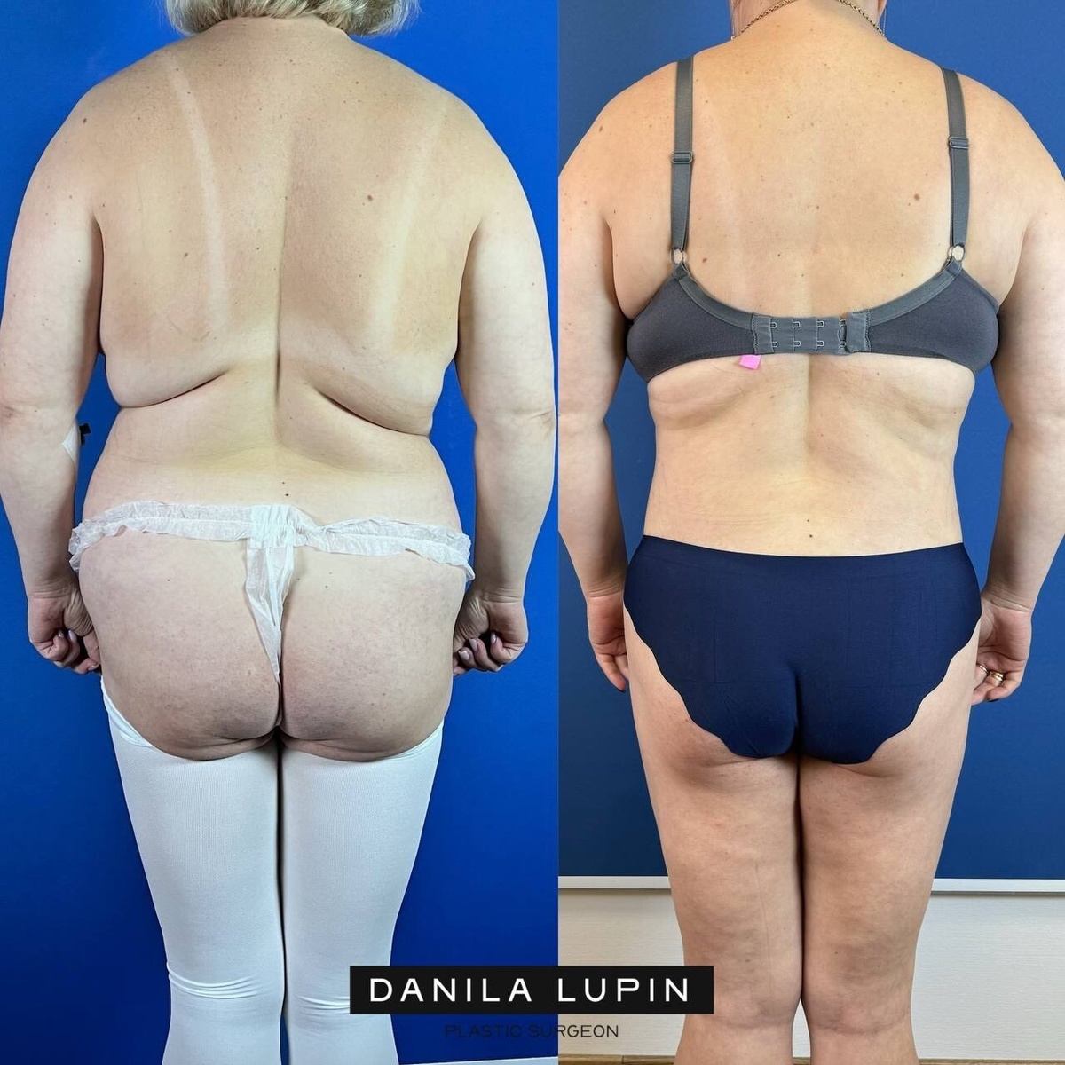 На фото пациентка Данилы Лупина. Имеются противопоказания, необходима консультация специалиста.