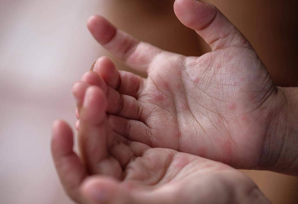 Признаки Вируса Коксаки.