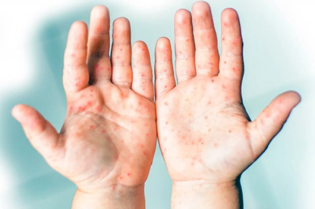    В Роспотребнадзоре организовали горячую линию для заболевших энтеровирусом