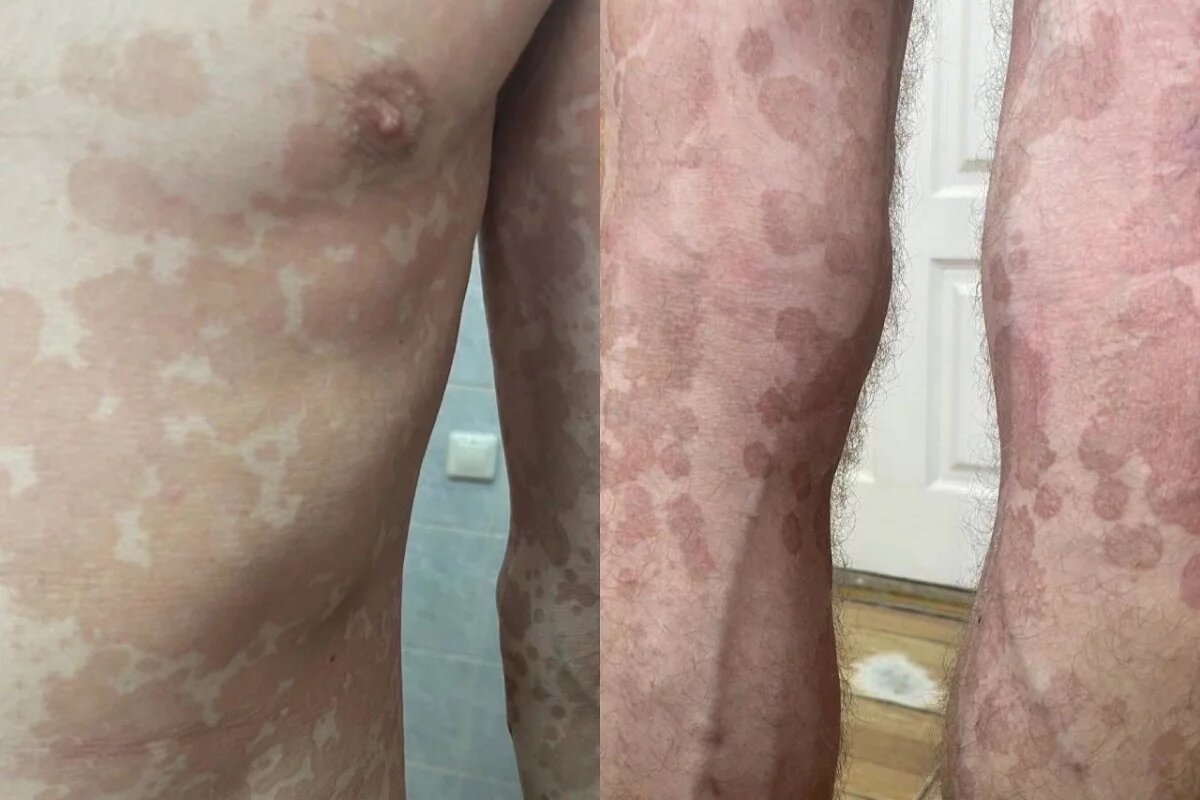    Два псковича с отрубевидным лишаем обратились в кожвендиспансер