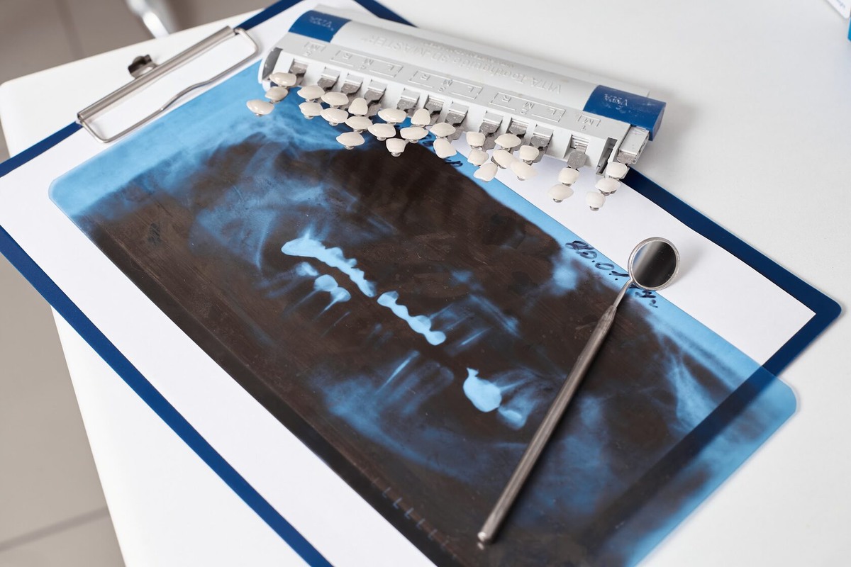 Лечение пульпита зуба в Первоуральске