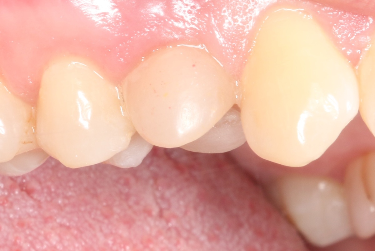 Временной коронке на импланте 1 месяц. Оцените состояние десны – насколько натурально она выглядит.