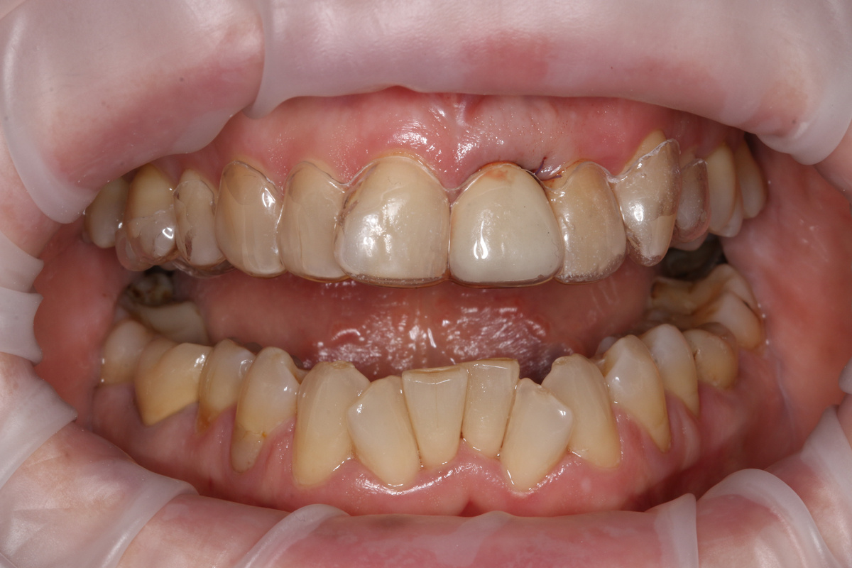 Удален центральный левый резец на верхней челюсти. В каппу вклеена коронка удаления зуба (заботливо отпилена от корня и отполирована ортопедом).