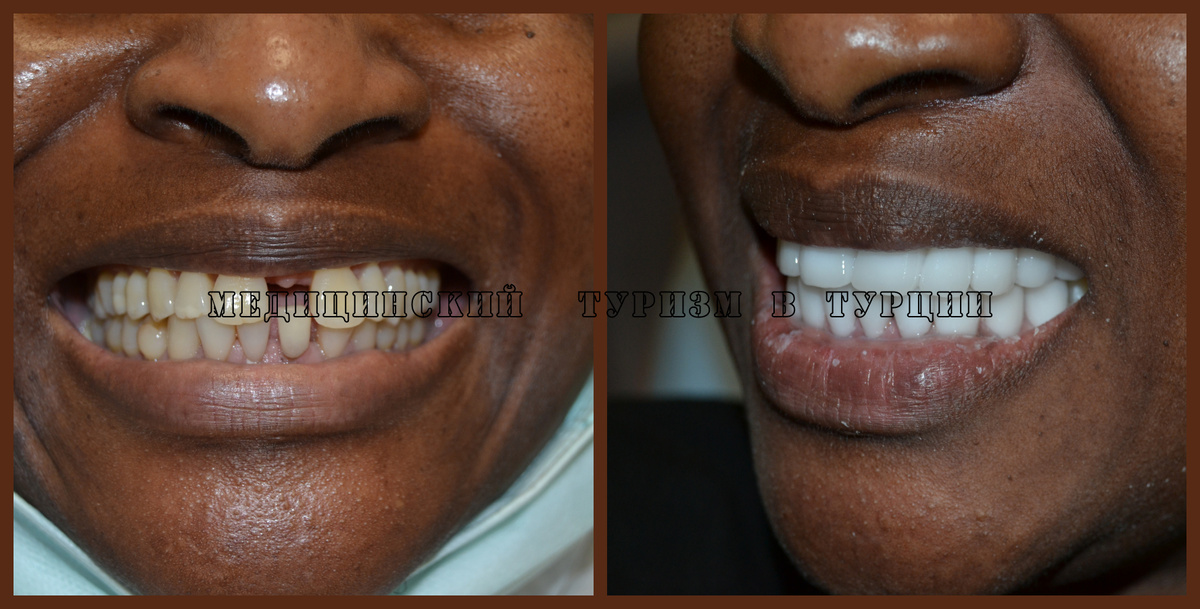 Результат лечения в стамбульской клинике