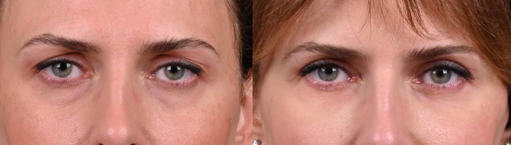 Пластика верхних век с липофилингом и трансконъюктивальная блефаропластика. Фото до и после. Фото с сайта хирурга Д.Р. Гришкяна. Имеются противопоказания, требуется консультация специалиста