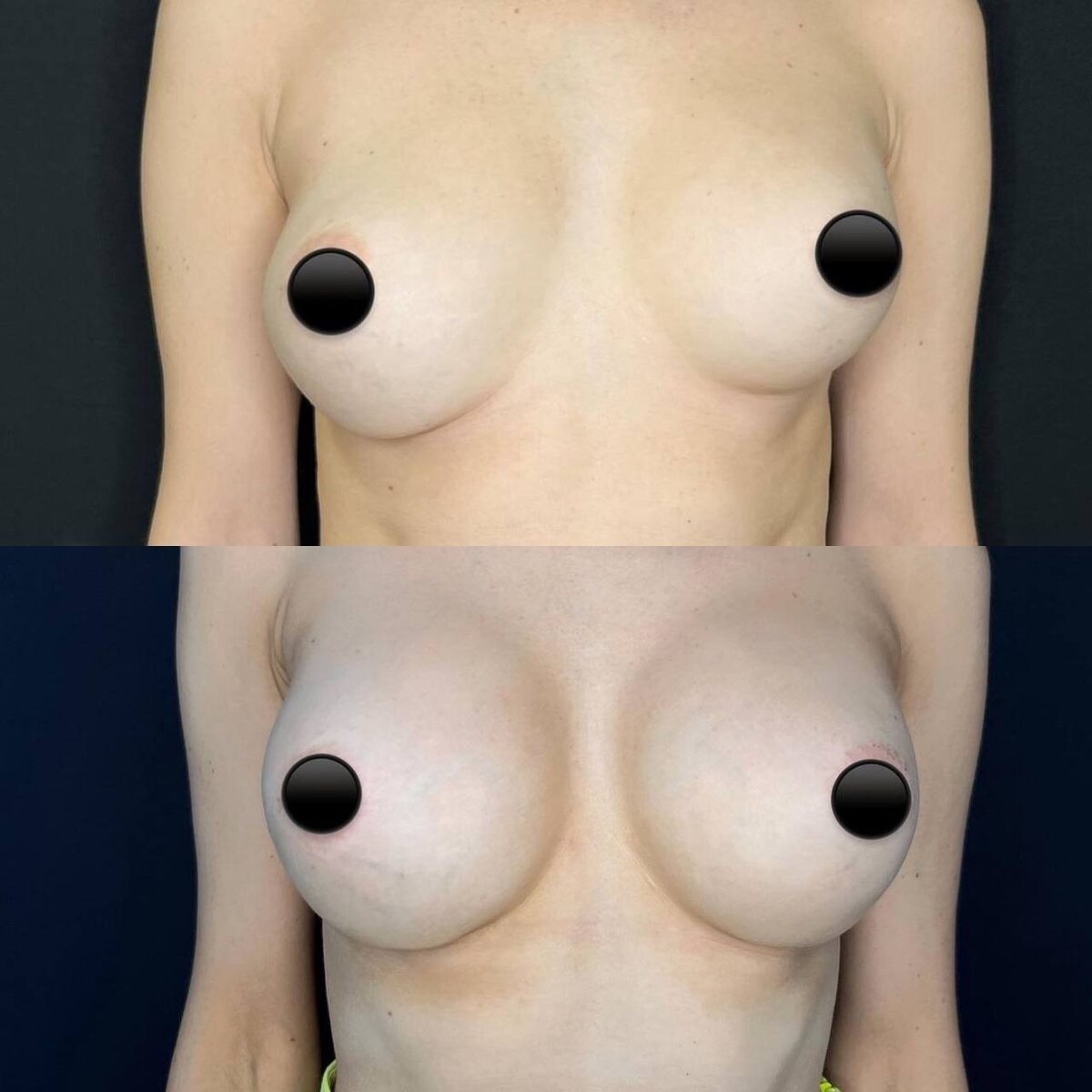 10 месяцев после повторной маммопластики