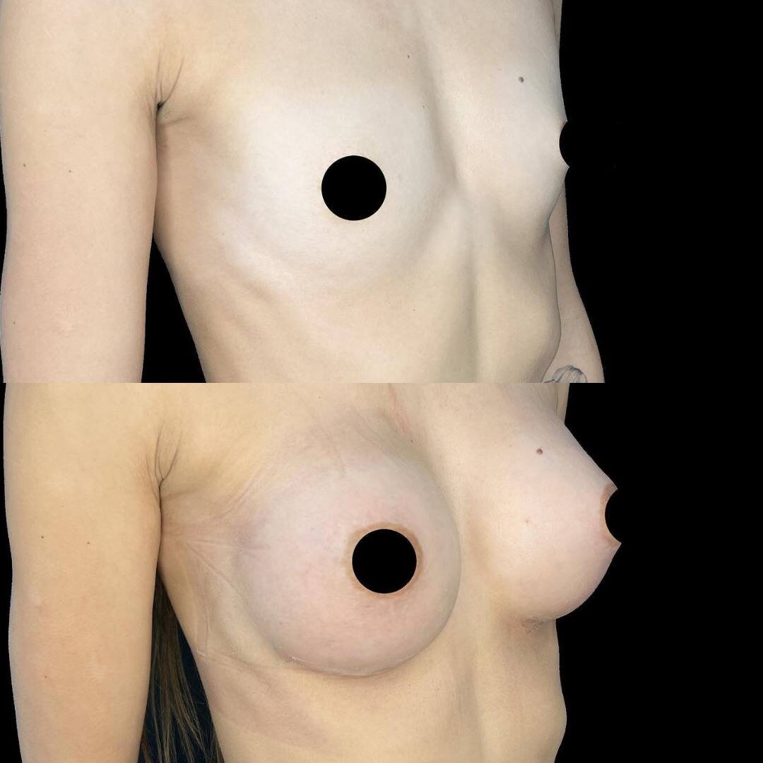 Месяц после увеличения груди круглыми имплантами