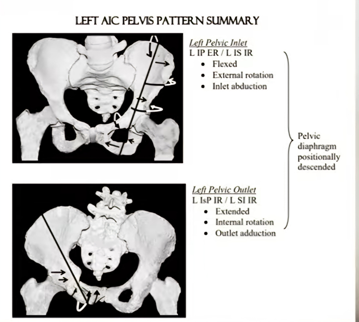 Положение костей таза когда левая половин развёрнута наружу, а правая остаётся внутри.