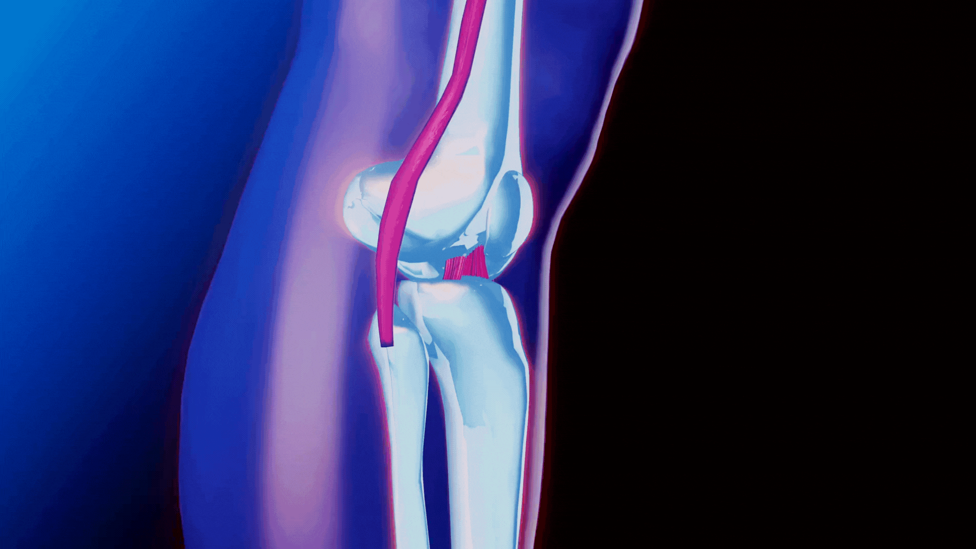 Разрыв коленных связок, в частности передней крестообразной связки (ПКС), приводит к значительным изменениям. При этом нарушается не только стабильность сустава, но и его функциональность. 