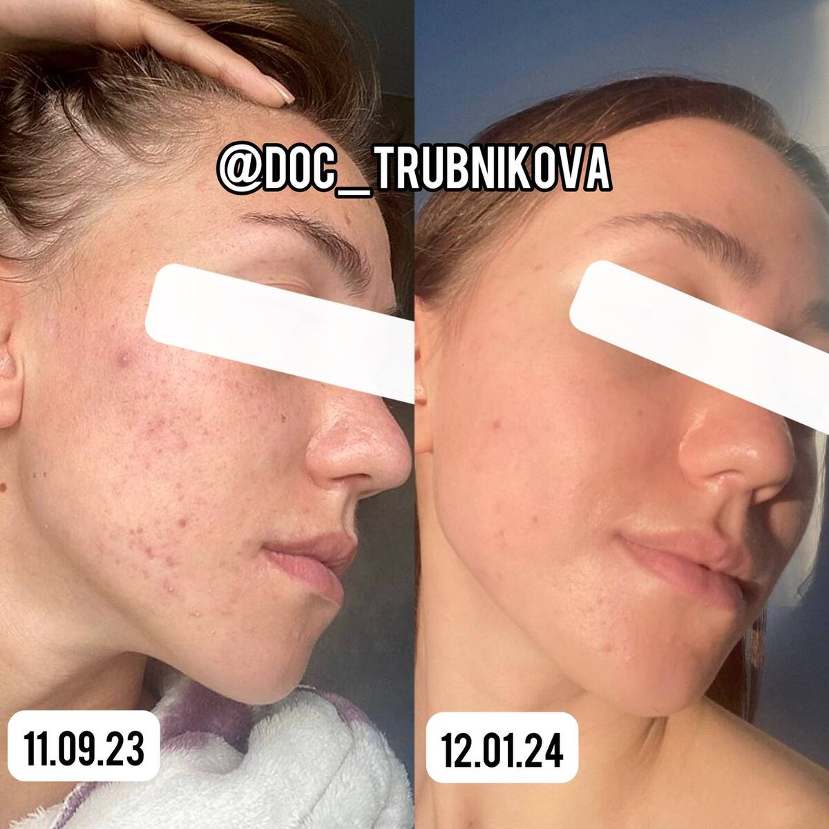 Всего 4 месяца и акне позади 🫶