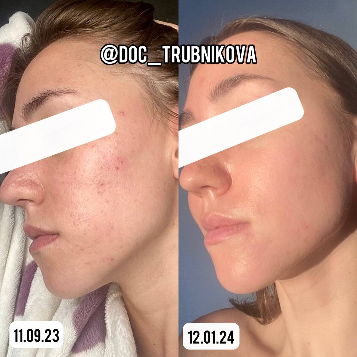 Кожа с эффектом фотошопа - залог уверенности 