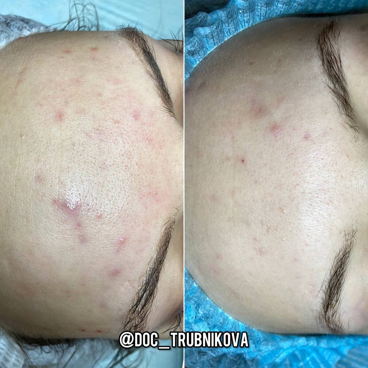 Косметология - отличное сопровождение лечения акне, но не его замена на все 100%☝️