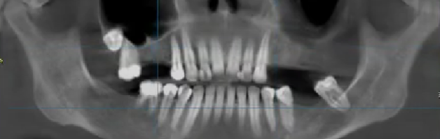 В общей сложности у пациентки недоставало 9 зубов 