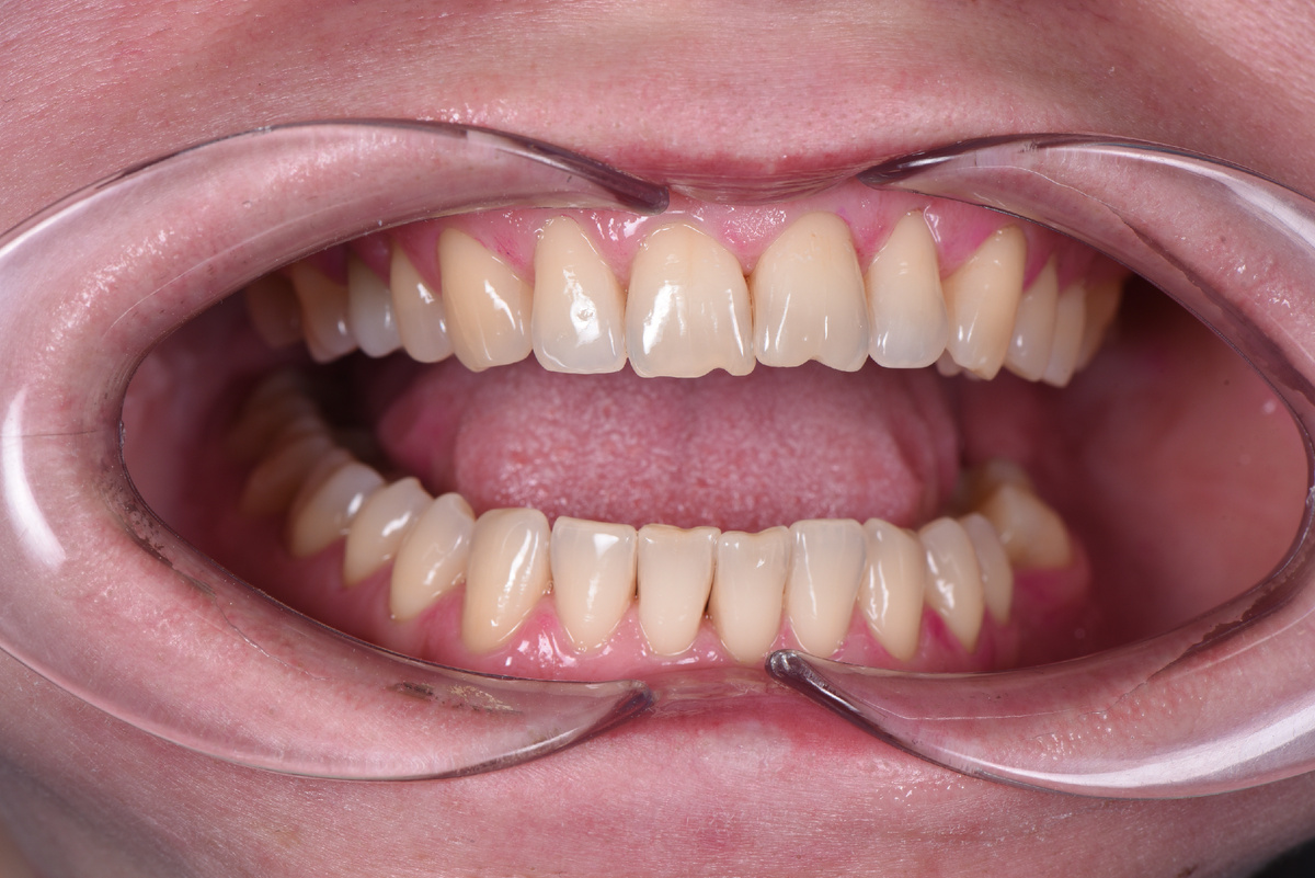 На нижних «единичках» тоже есть характерные выемки 