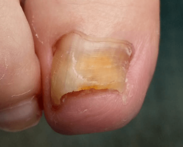 Ноготь, пораженный грибком