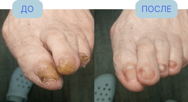 Ногти, пораженные грибком, до и после обработки