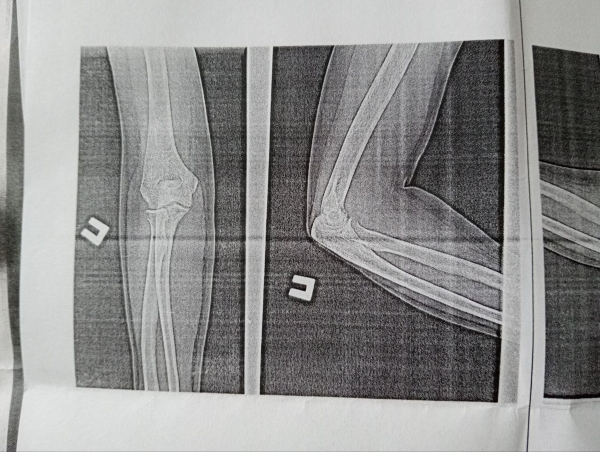 Красивые косточки )) Снимок локтевых суставов