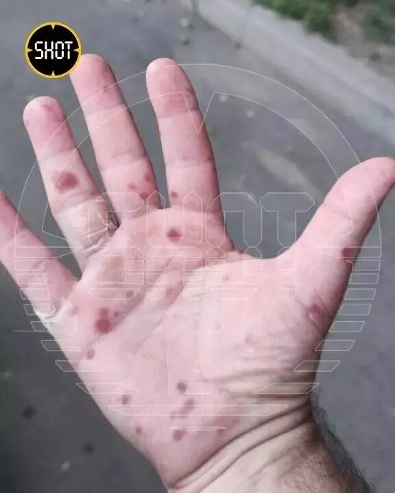 Симптомы заболевания, похожие на энтеровирусную инфекцию Коксаки, выявили уже минимум в девяти регионах. Фото: SHOT