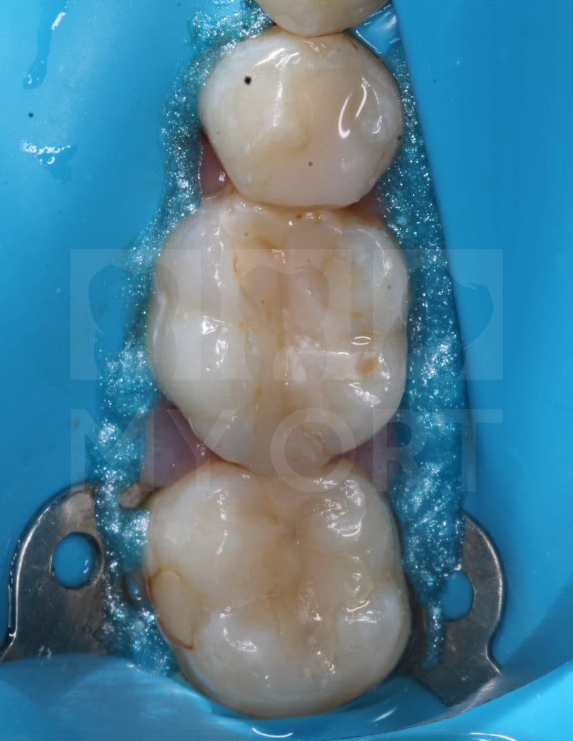 Исходная ситуация. 46 и 47 зуб