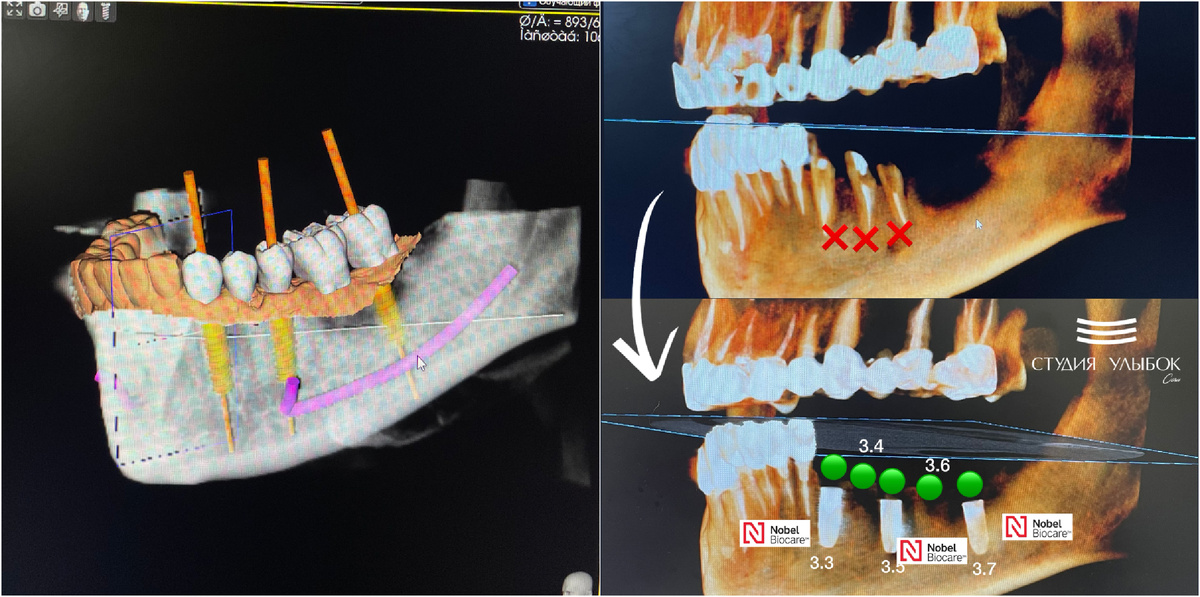 Операция по установке 3-х имплантатов Nobel Beocare
