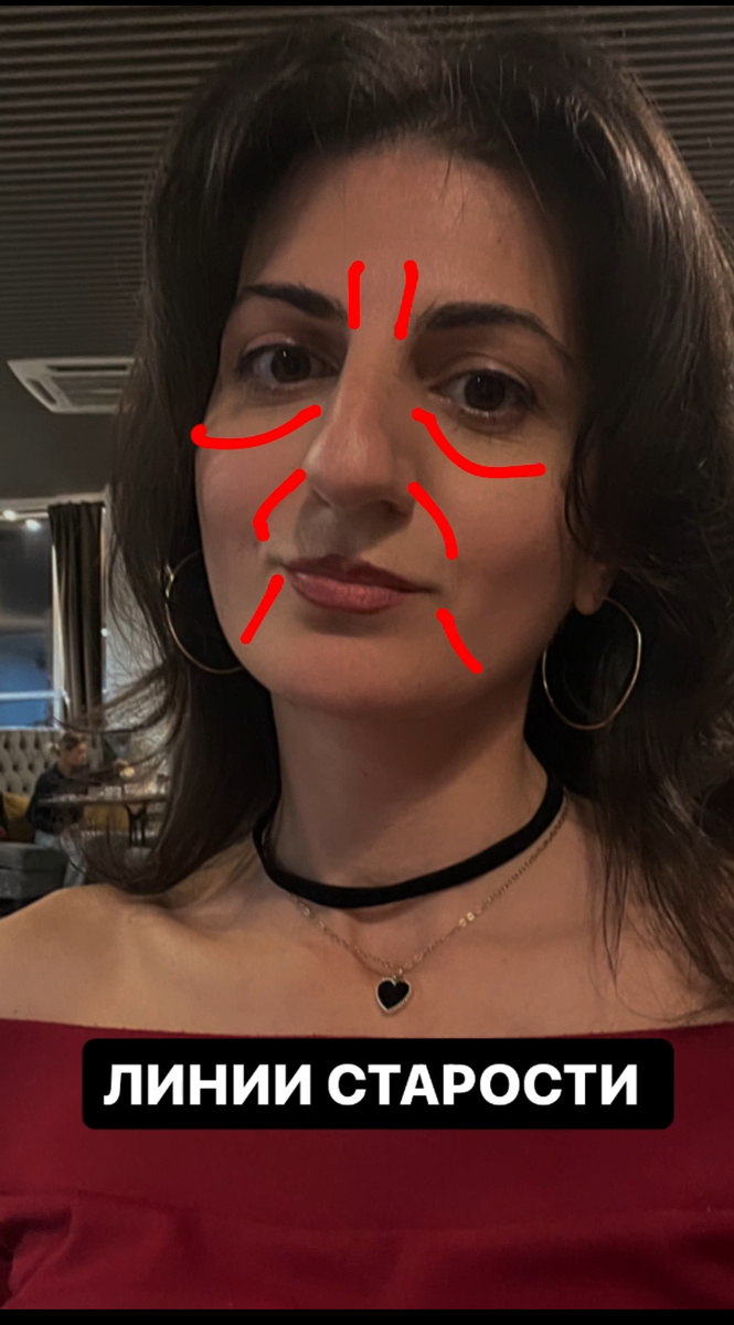-У нас есть мышцы, которые опускают уголки губ и нижнюю губу - они называются мышцы депрессоры ( достаточно маленькие , но сильные ) И с возрастом эта группа мышц становится жесткими и укороченными . Силу гравитации никто не отменял и пока не смог остановить ( а оно и не надо ‼️)

-Носогубные складки - тоже под силой гравитации и в следствии возраста ( а так же режима сна и питания ) , образуются так называемые некрасивые валики .

-Носослездная борозда - придаёт очень тяжелый взгляд  и накидывает так несколько лет на ваш красивый возраст . А оно нам надо ?😎

-И конечно- царица , хмурая межбровка 😠 

И вот такой комплект визуально создает на лице старое , грустное и злое лицо .

Я думаю тут понятно , что  поменьше нытья и недовольства !

И чтобы эта конструкция перестала расти вниз - важно начать прорабатывать с грудных мышц .

Ну, а самая полная методика работы с лицом у меня на курсе по фейс -фитнесу и самомассажу 🌺
🌟 Индивидуальные упражнения по фейс -фитнесу 
🌟 Японский самомассаж Кобидо 
🌟 Точечный самомассаж Шиацу 
🌟 Массаж камнем Гуаша 
🌟 Упражнения для ровной спины 
🌟 Основы питания 
🌟 Как правильно читать и подбирать косметику 

И много полезной информации ♥️ 

‼️А какие линии уже есть на твоем лице ?

Пиши слово СТОП 🛑  и я проведу тебе БЕСПЛАТНО онлайн диагностику состояния лица 