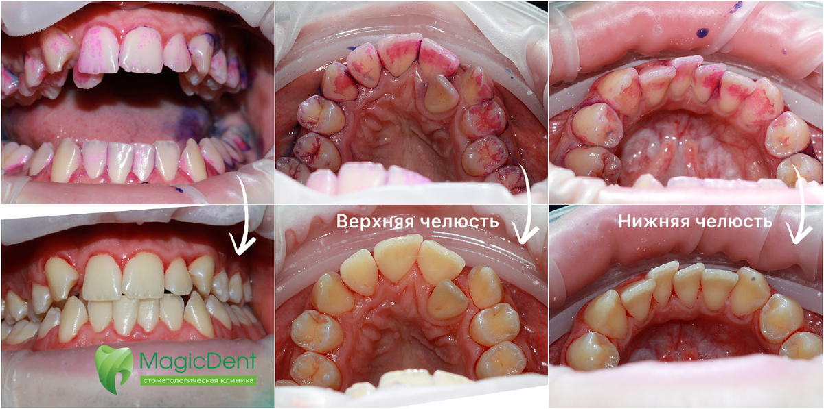 Чистка зубов у пациента со скученностью зубов