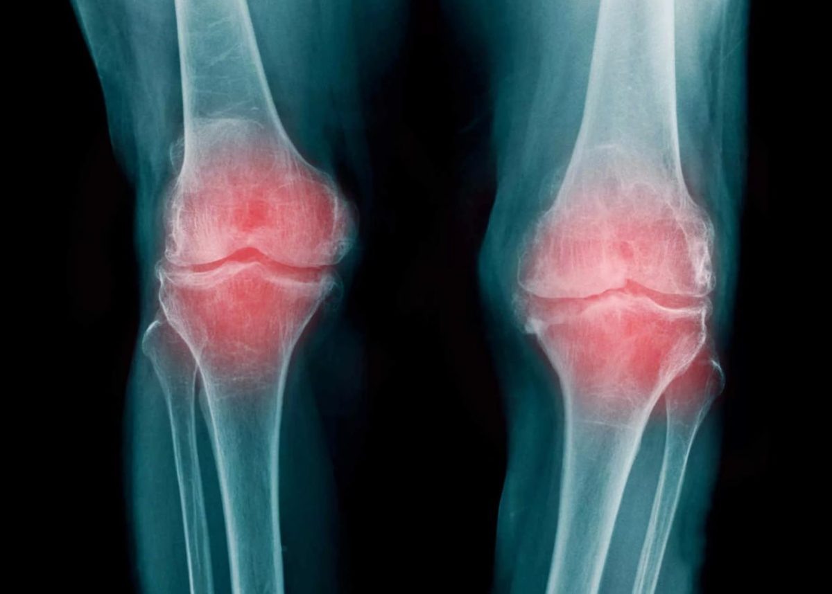    Со временем болезнь перешла на суставы