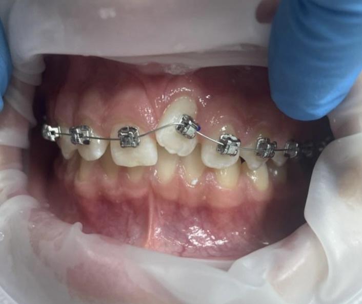 Экструзия зуба 2.1 через 1.5 месяца после установки б\с 