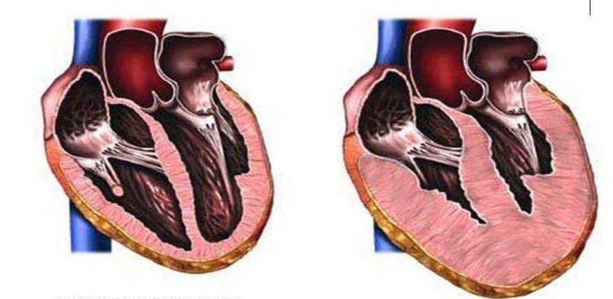 Гипертрофия миокарда