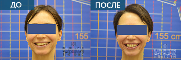 Исправление прикуса у взрослого пациента ДО и ПОСЛЕ