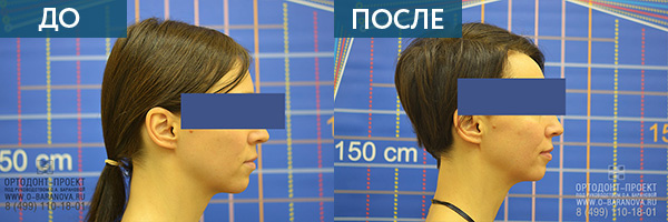 Исправление прикуса у взрослого пациента ДО и ПОСЛЕ