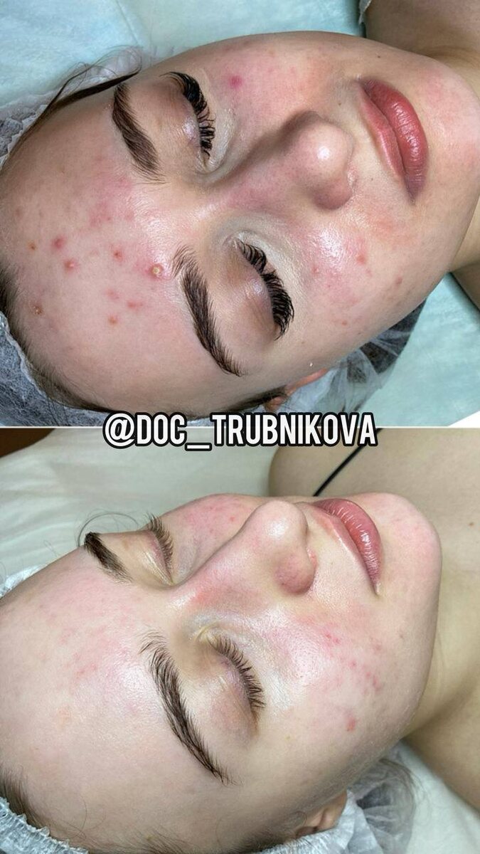 Прекрасно видна динамика: исчезновение гнойничковых высыпаний, уменьшение красноты кожи и сокращение диаметра пор 😍