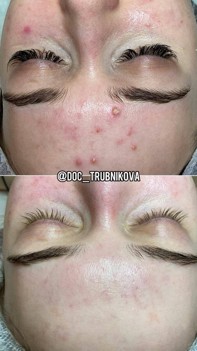 Восхитительное до-после курса пилинга с азелаиновой кислотой 20% ❤️ 