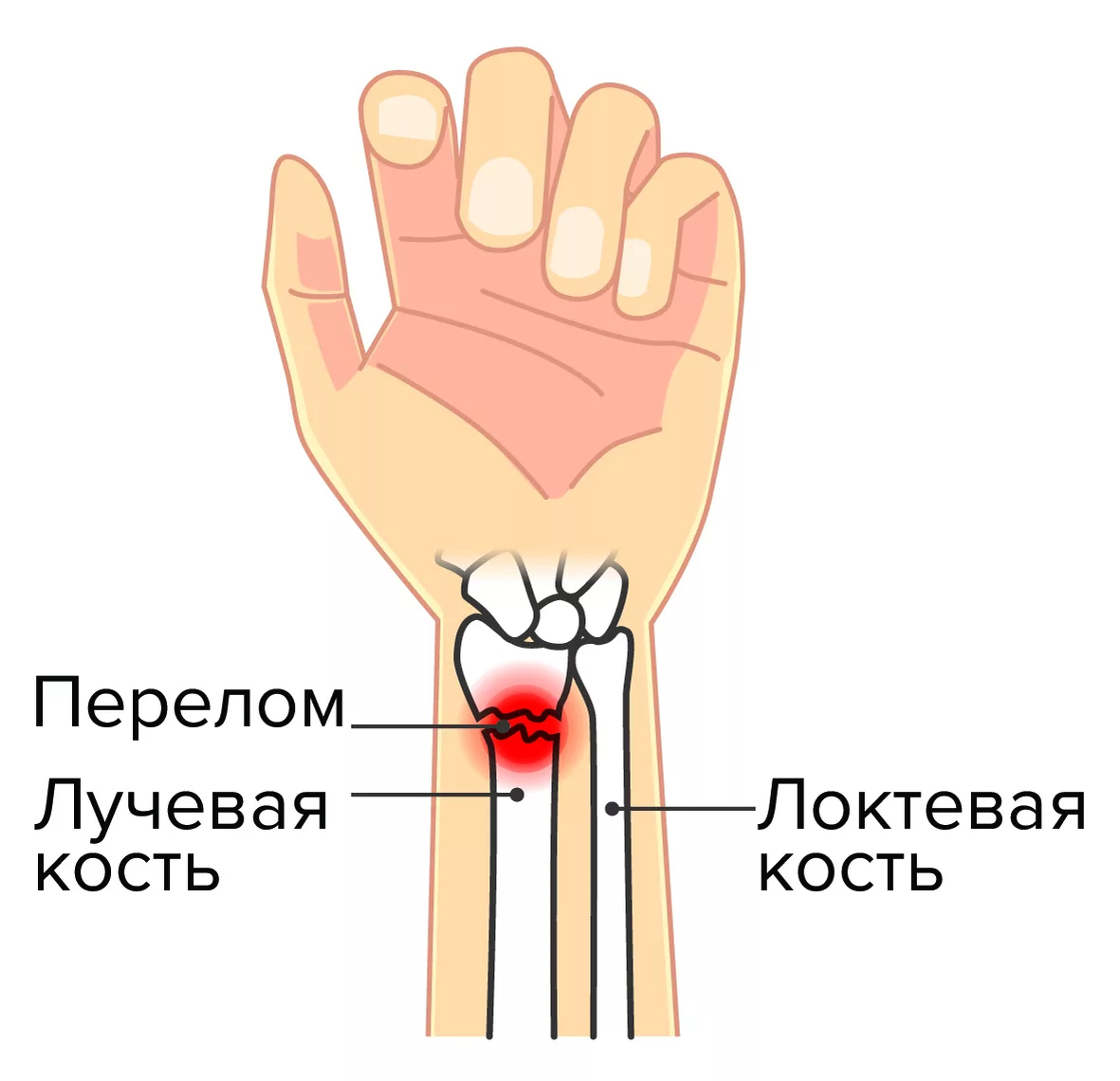Типичное место перелома при падении на вытянутую руку
