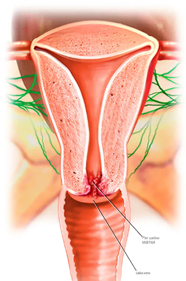 Рак шейки матки начинается в клетках шейки матки.