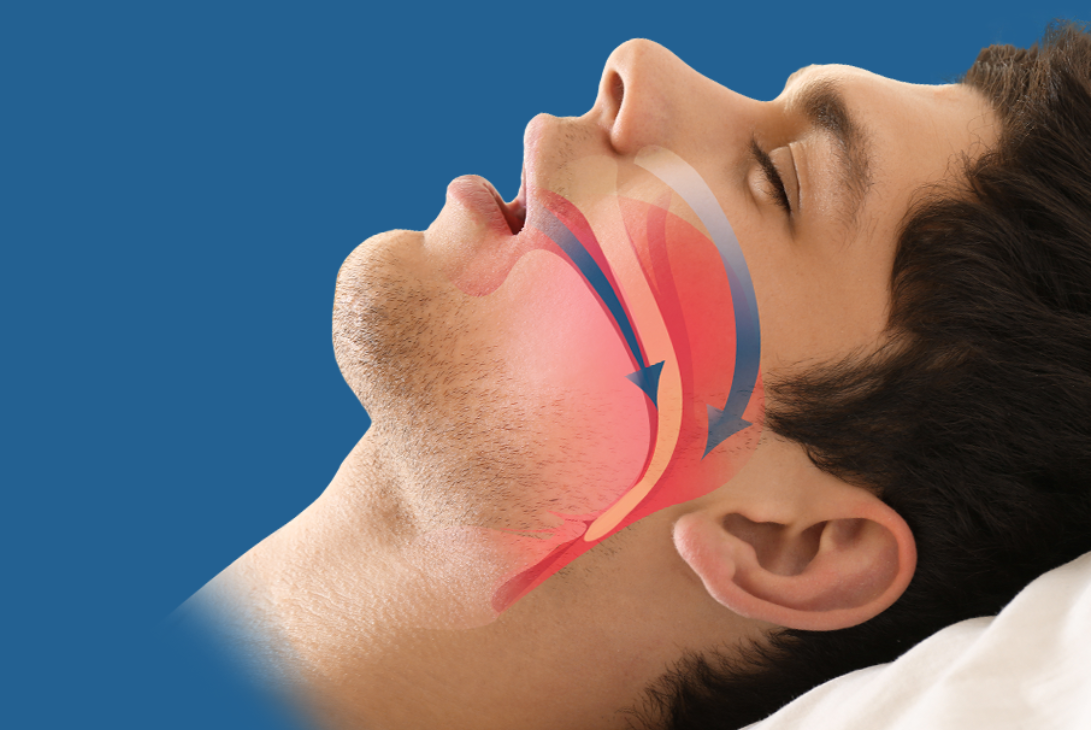 Всё, что нужно знать об апноэ