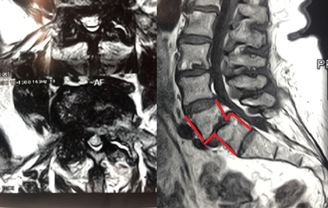Истинный листез - смещение позвонка